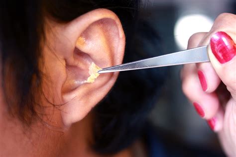 Thank you for watching our ear wax removal video today. The ear wax extraction featured in todays video was carried out using endoscopic microsuction. This p...